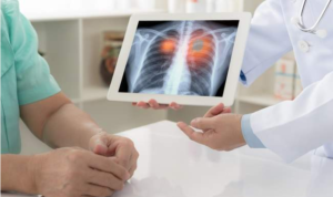 Câncer de pulmão: entenda as causas, sinais e tratamentos da doença